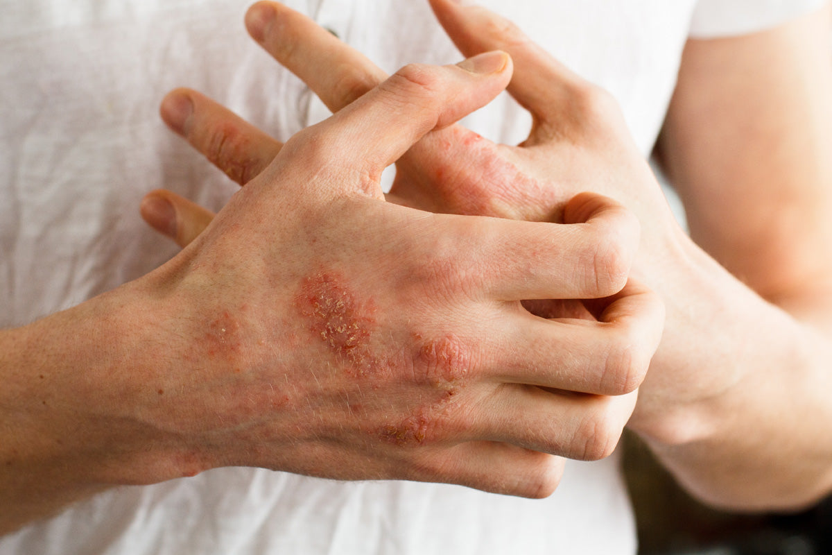 Finding Relief: How to Calm Eczema Itch Naturally